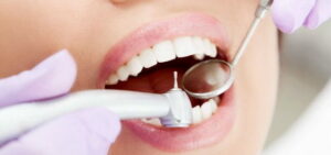 удаление зубных отложений