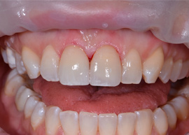 Керамические виниры передних двух зубов