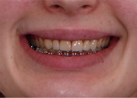 Коррекция улыбки после ортодонтического лечения  керамическими винирами