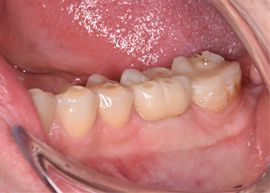 Керамическая коронка на жевательный зуб
