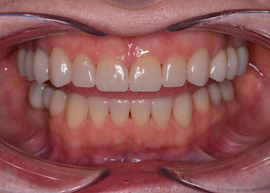 Полная тотальная реабилитация улыбки пациента керамическими винирами и коронками на своих зубах и имплантах