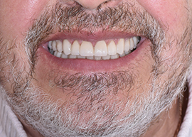 Керамические виниры и накладки на своих зубах